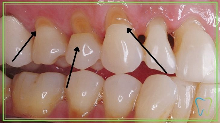 ab-fractions dentista ammendolia velletri