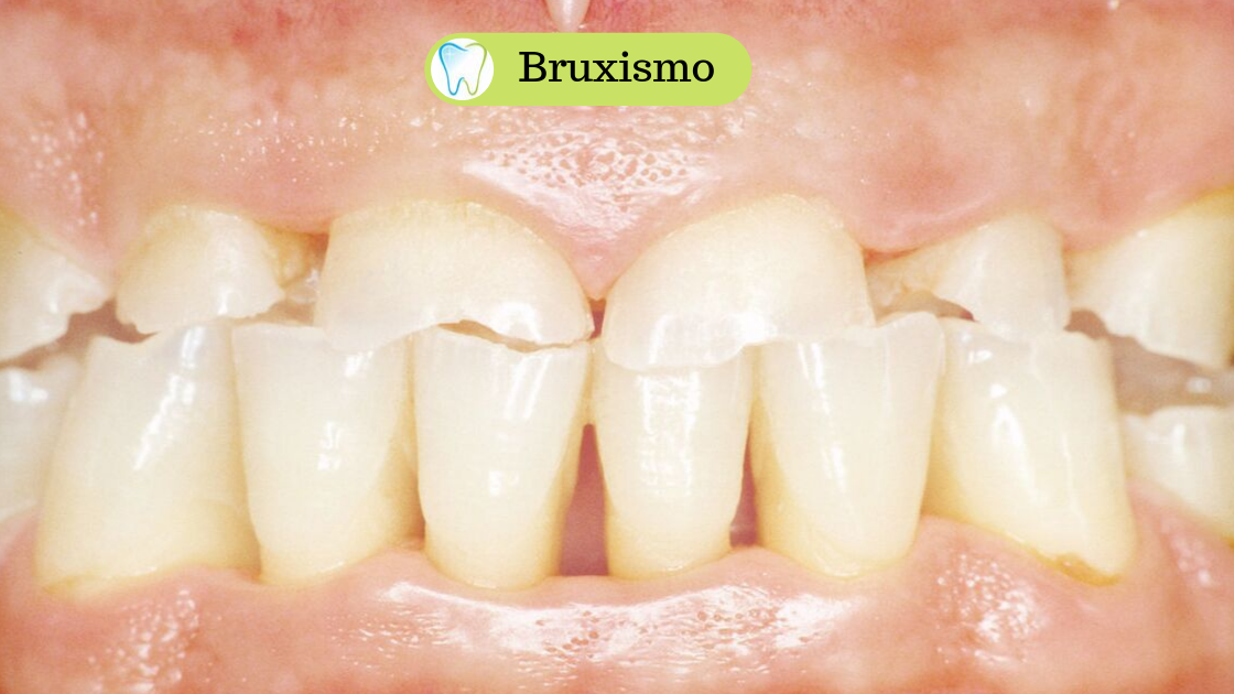 Bruxismo - Combattilo proteggendo i tuoi denti