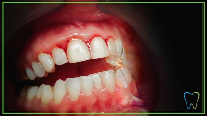 gengive sanguinamento dentista ammendolia