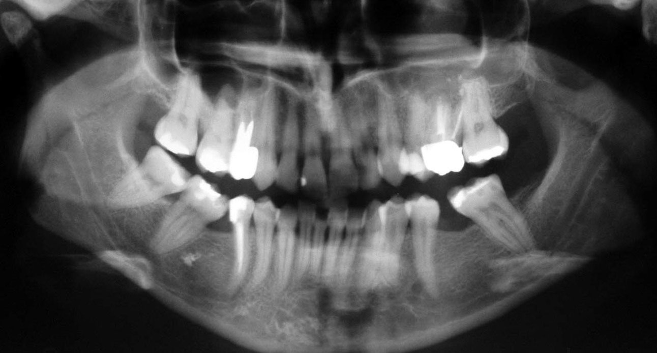 Panoramica Dentale Cosa Si Vede Ortopantomografia-–-Panoramica-dentale-velletri – Dentista Ammendolia
