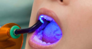 otturazione denti ammendolia dentista velletri