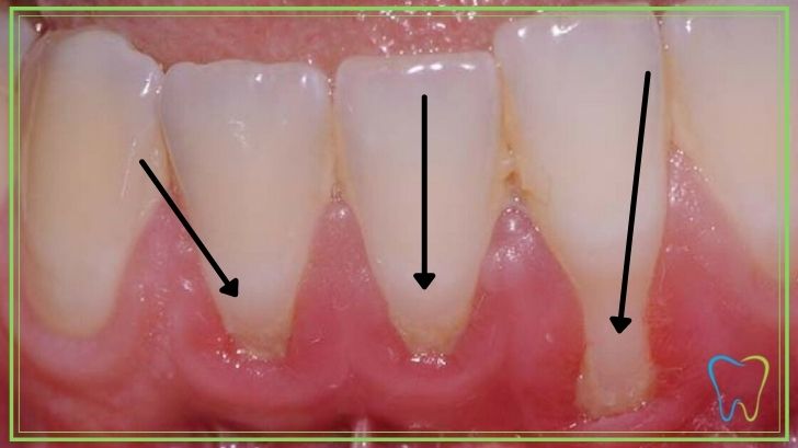 recessioni gengivali dentista ammendolia velletri