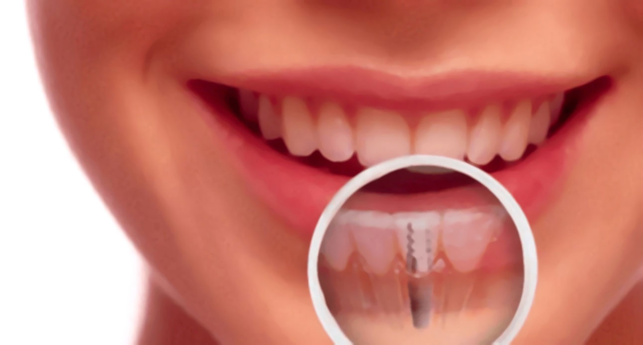Implantologia<br />
denti