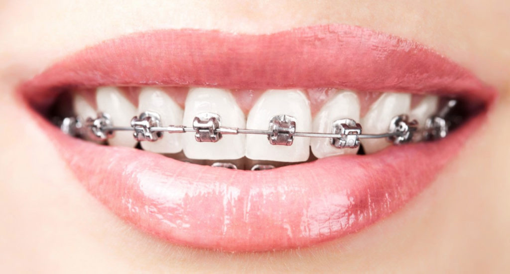 ortodonzia fissa velletri dentista ammendolia