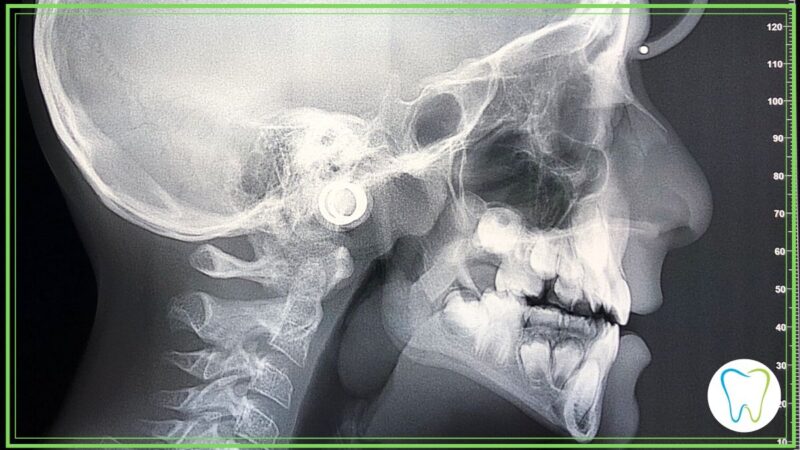 cefalometria dentista velletri ammendolia