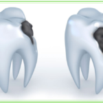 Carie dentaria carie dentaria dentista velletri ammendolia