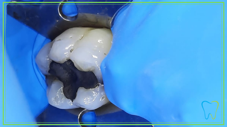 isolamento diga gomma dentista velletri
