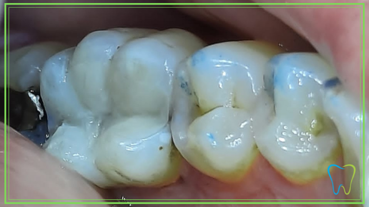 otturazione composito dentista ammendolia velletri
