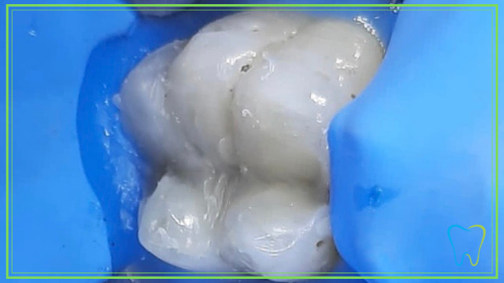 otturazione composito dentista ammendolia velletri