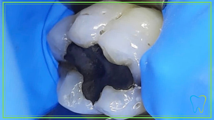 rimozione amalgama dentista velletri ammendolia