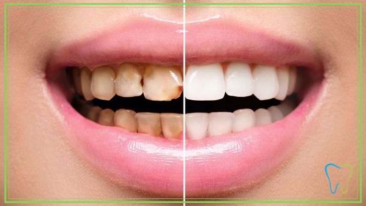 capsule dentali velletri dentista ammendolia