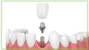 impianto dentale abutment dentista ammendolia