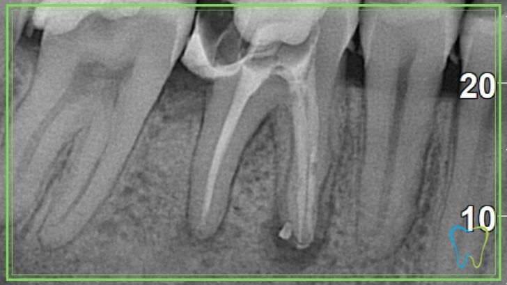 endodonzia velletri dentista ammendolia