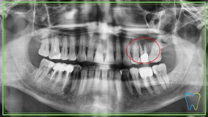 ortopanoramica dentale velletri dentista ammendolia