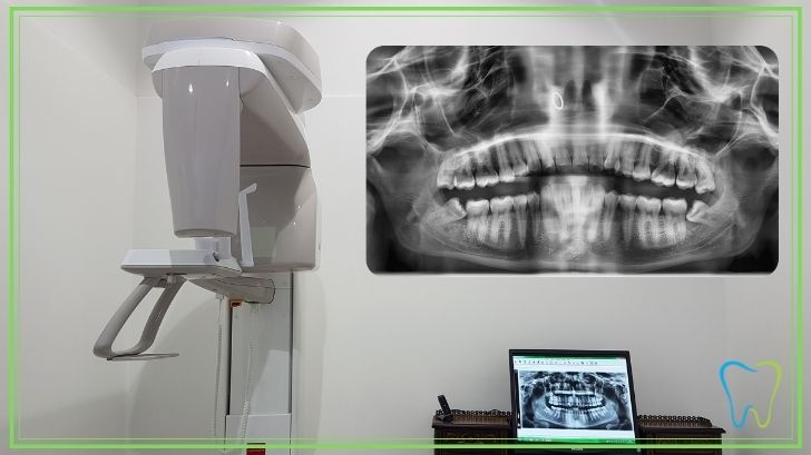 ortopantomografia dentale velletri dentista ammendolia